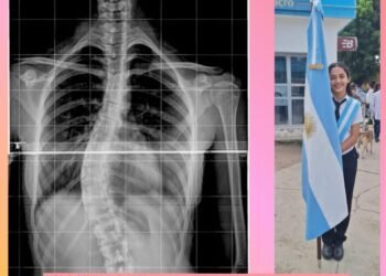 Jóven con escoliosis necesita recaudar más de $1 millón para operación en Salta
