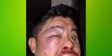 Lo desfiguraron en el baño de un boliche y la Policía no lo ayudó