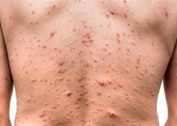 Confirmaron en Argentina el primer caso de la viruela del mono