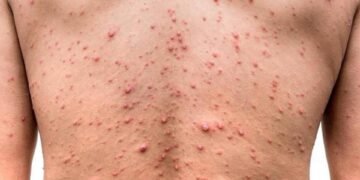 Confirmaron en Argentina el primer caso de la viruela del mono