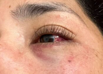 Iba en moto y la lastimaron con una bombucha