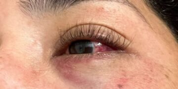 Iba en moto y la lastimaron con una bombucha