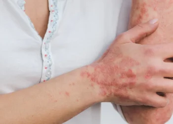 Confirmaron un caso de lepra en el departamento San Martín