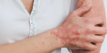 Confirmaron un caso de lepra en el departamento San Martín