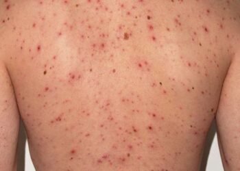 Alerta ante el riesgo sanitario por sarampión