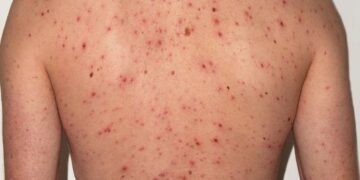 Alerta ante el riesgo sanitario por sarampión