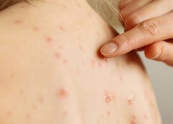 Sarampión: Nación confirmó un caso en Entre Ríos