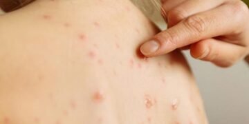 Sarampión: Nación confirmó un caso en Entre Ríos