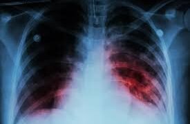En 2025 se notificaron 884 casos de tuberculosis en Salta