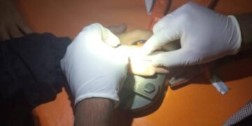 Bomberos extrajeron nuevamente un anillo a un vecino