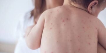 Confirmaron 137 casos de varicela en Salta 