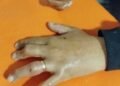 Bomberos le retiraron un anillo a otra vecina