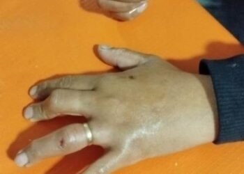 Bomberos le retiraron un anillo a otra vecina