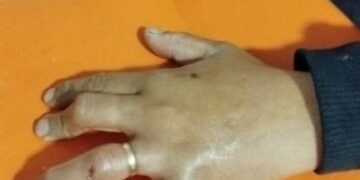 Bomberos le retiraron un anillo a otra vecina